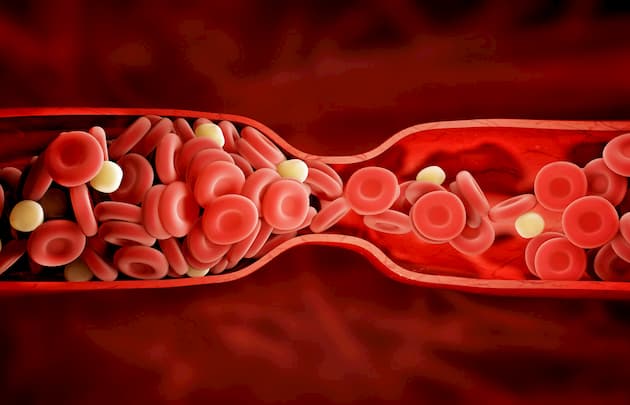 blood clotting cause strokes