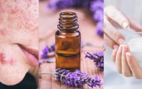 Essential-Oils-Treat-Acne-Naturally