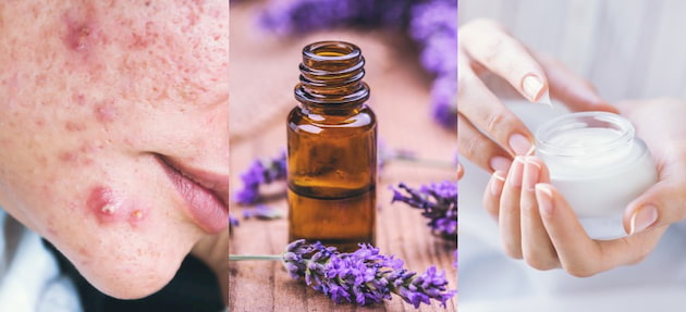 Essential-Oils-Treat-Acne-Naturally